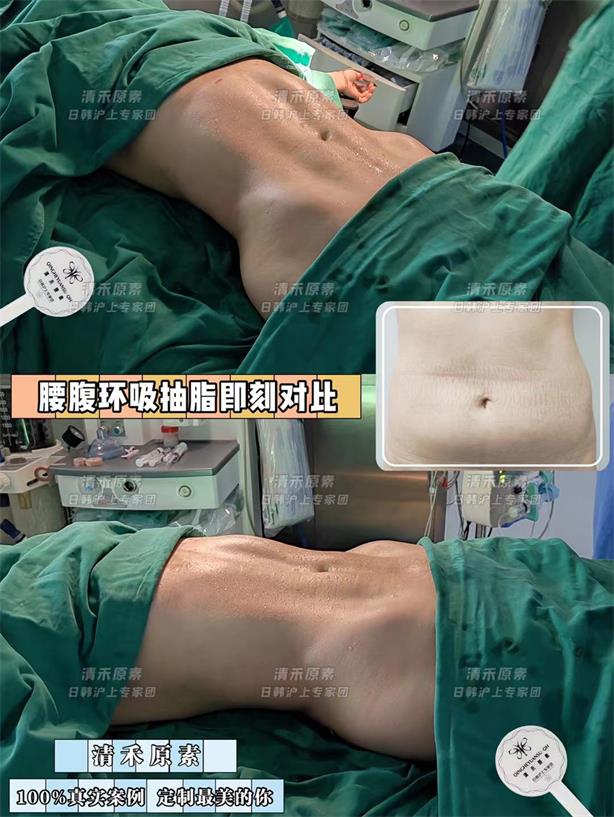 腰腹环吸抽脂